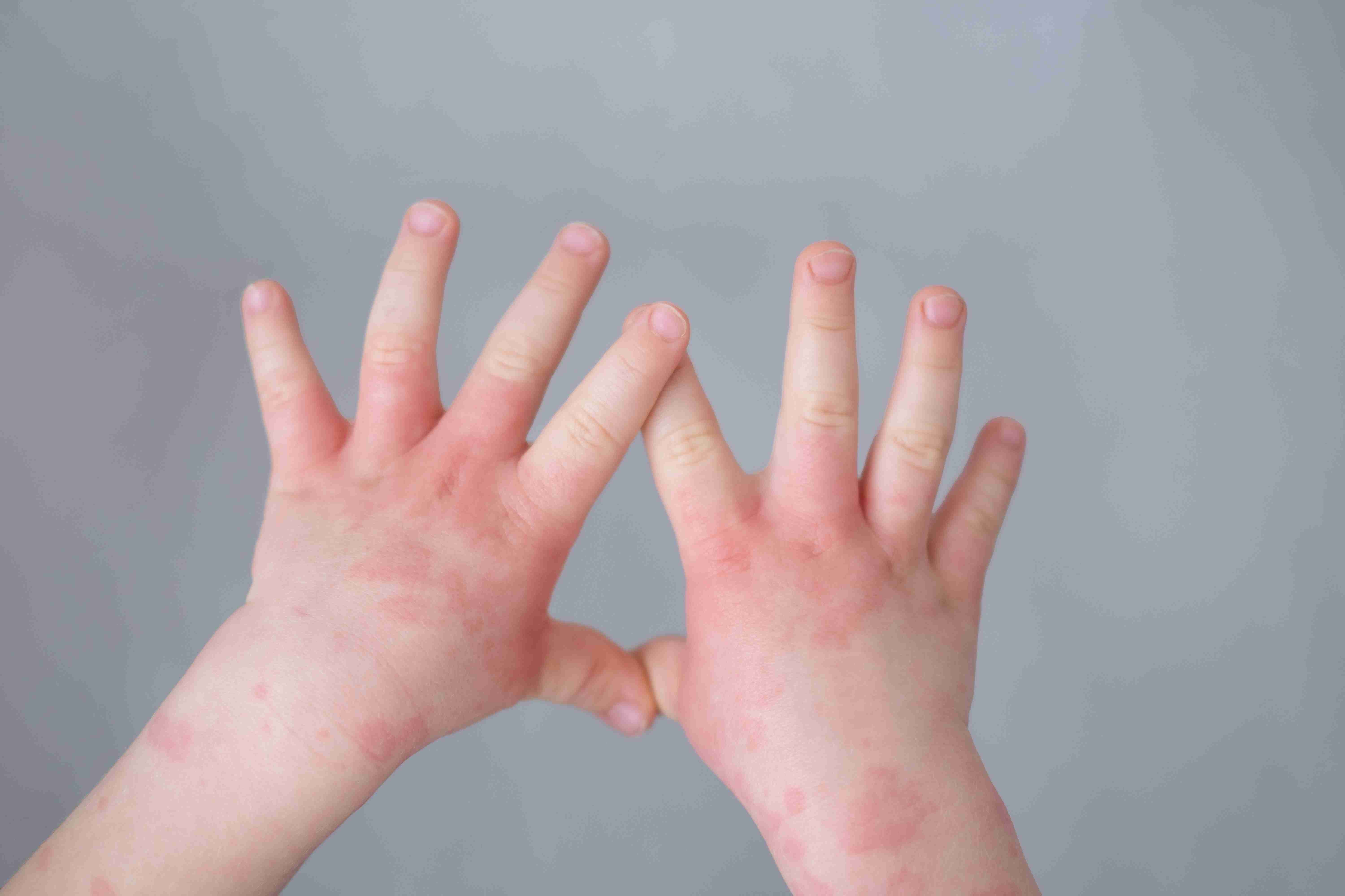 Contact Dermatitis