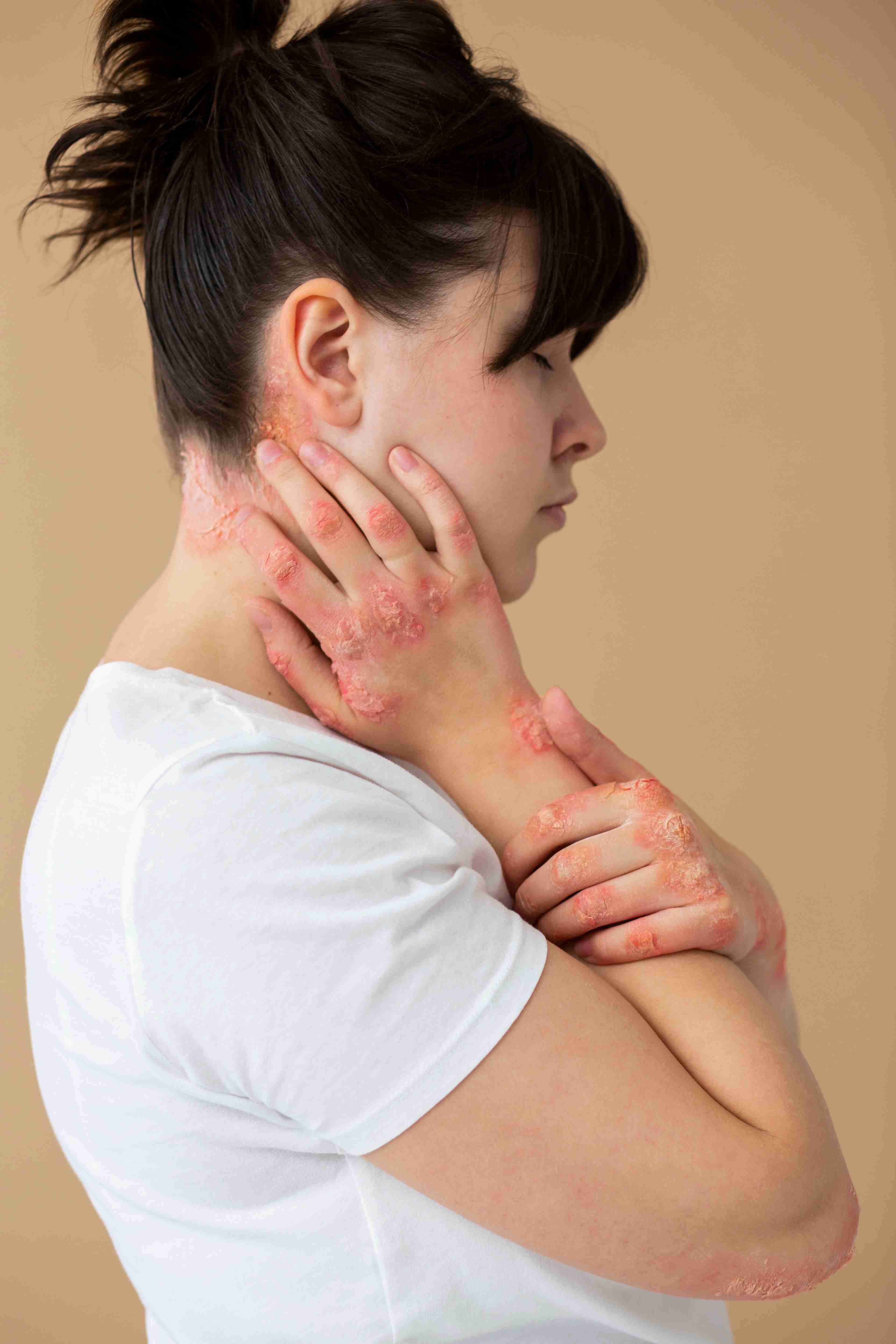 Eczema