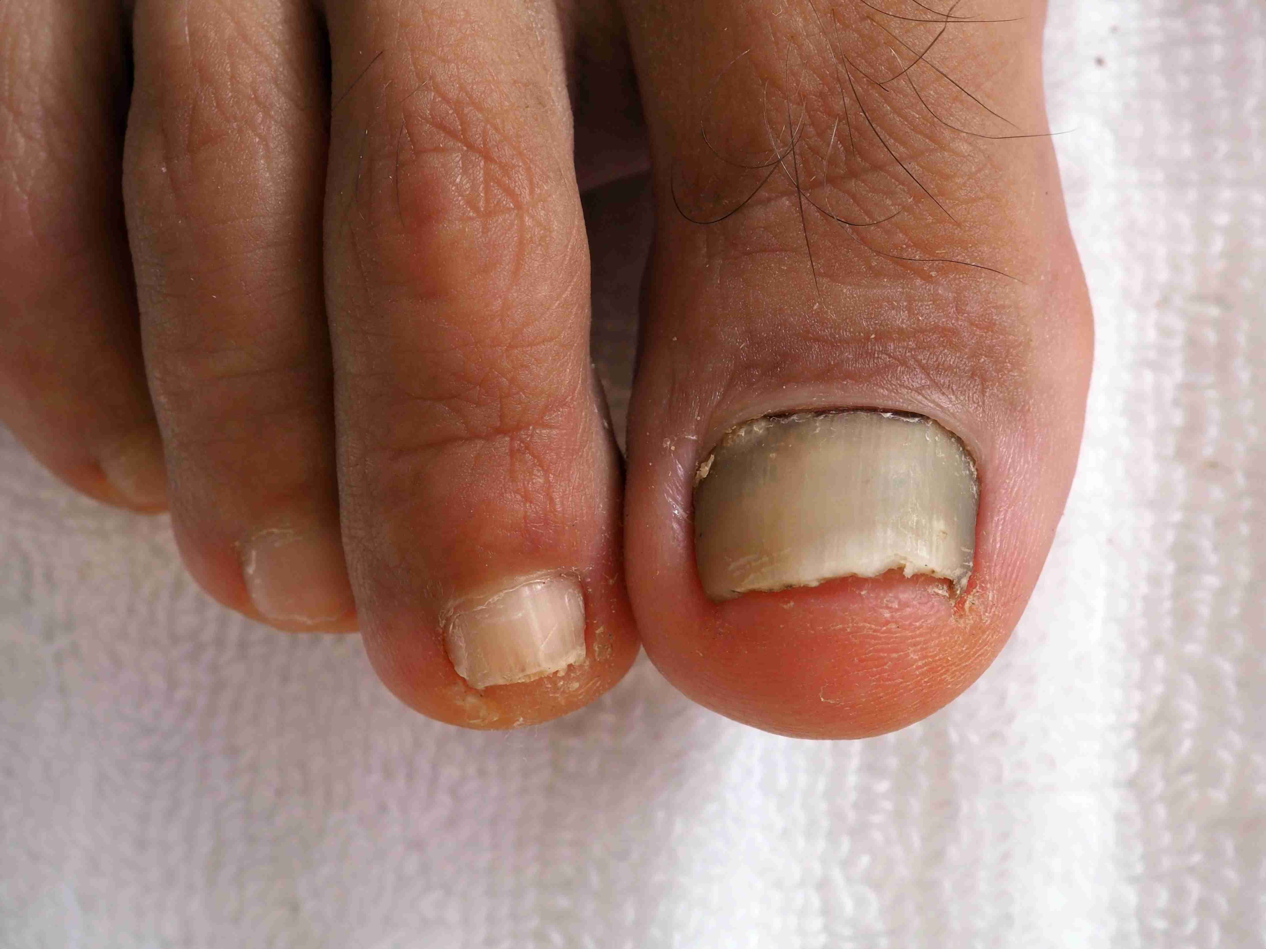 Ingrowing Toe Nail