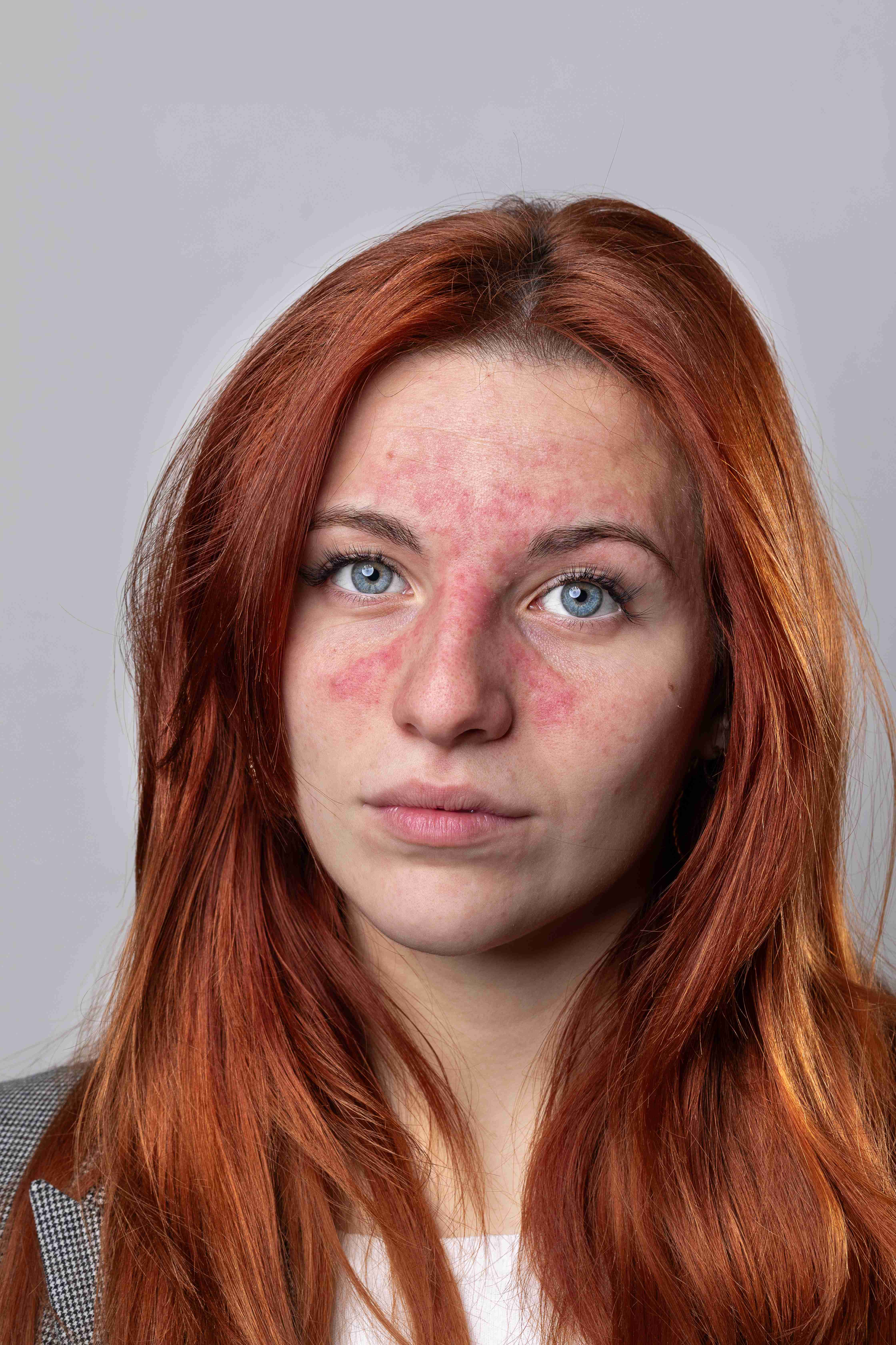 Rosacea